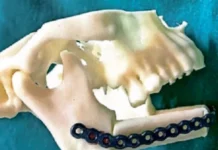 एम्स भोपाल का बड़ा कारनामा, 3D प्रिंटिंग और पैर की हड्डी से बनाया कैंसर मरीज का नया जबड़ा